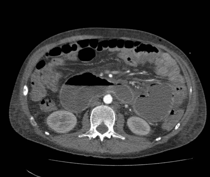 File:Bowel lymphoma complicated by bleeding after therapy (Radiopaedia 55601-62110 B 36).jpg
