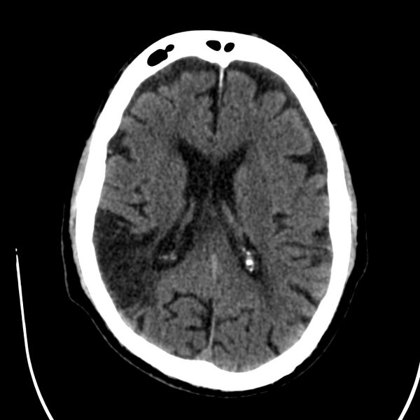 File:Brain Pantopaque remnants (Radiopaedia 78403-91048 Axial non-contrast 57).jpg