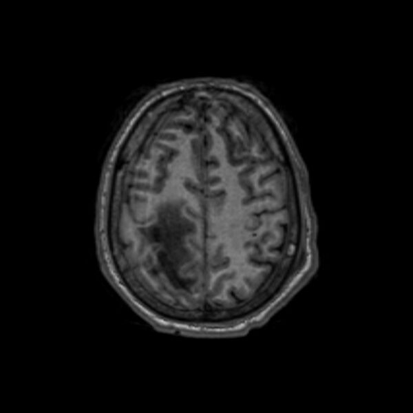 File:Brain abscess complicated by intraventricular rupture and ventriculitis (Radiopaedia 82434-96577 Axial T1 57).jpg