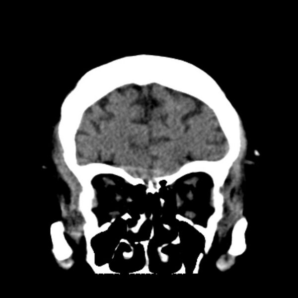 File:Brain cortical laminar necrosis (Radiopaedia 25822-25971 C 12).jpg