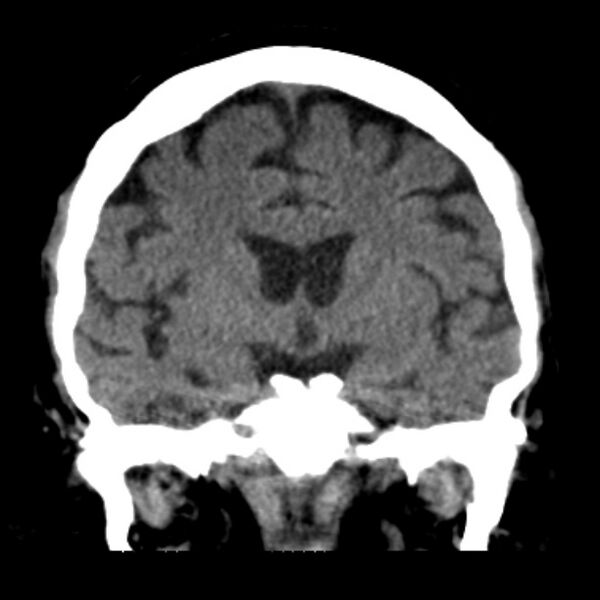 File:Brain cortical laminar necrosis (Radiopaedia 25822-25971 C 25).jpg