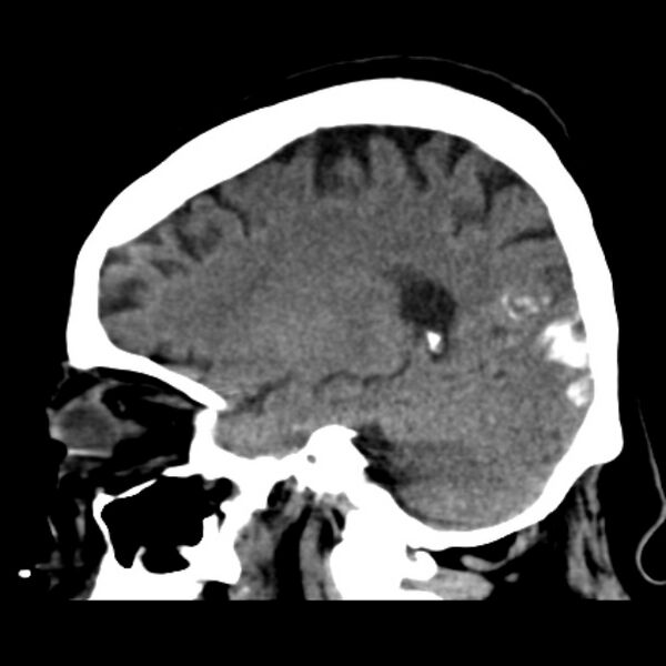 File:Brain cortical laminar necrosis (Radiopaedia 25822-25971 non-contrast 19).jpg