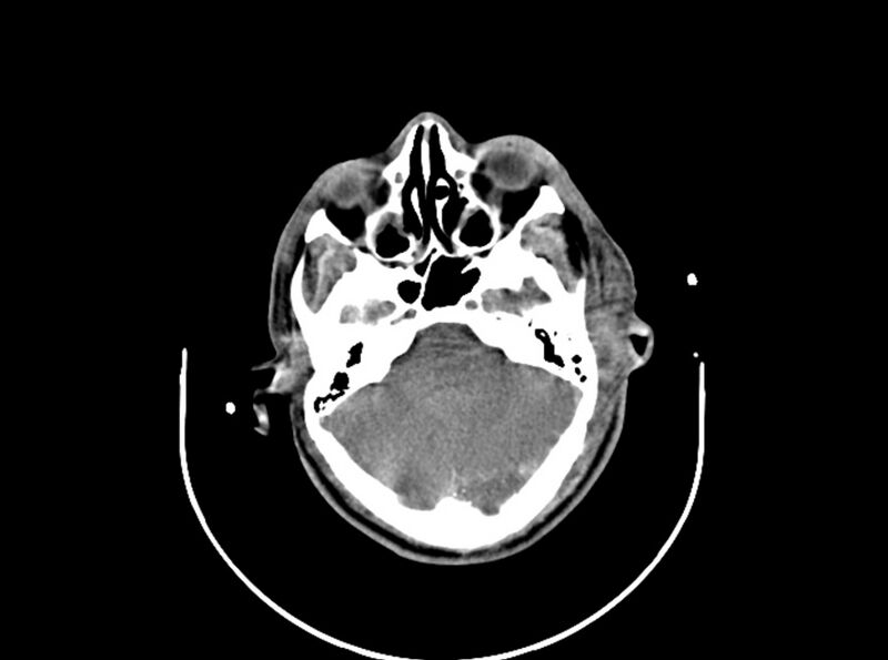 File:Brain injury by firearm projectile (Radiopaedia 82068-96087 B 66).jpg
