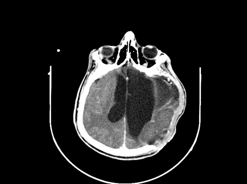 File:Brain injury by firearm projectile (Radiopaedia 82068-96088 B 136).jpg
