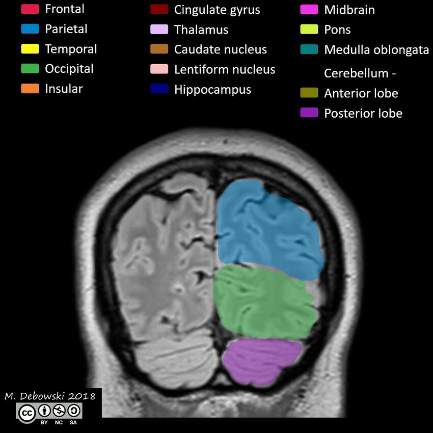 Brain lobes - annotated MRI (Radiopaedia 61691-69700 Coronal 62).JPG