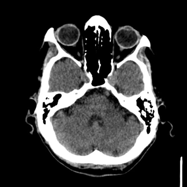 File:Brain metastases from lung cancer (Radiopaedia 27849-28092 Axial non-contrast 13).jpg