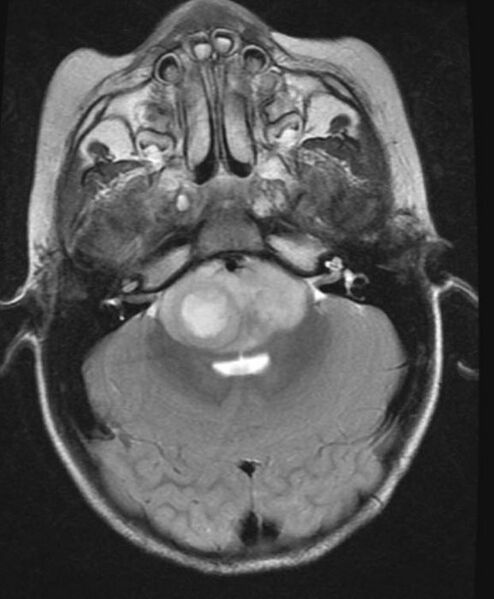 File:Brainstem glioma (Radiopaedia 11250-11614 C 1).jpg