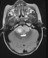 Brainstem glioma (Radiopaedia 11250-11614 C 1).jpg