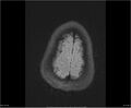 Brainstem glioma (Radiopaedia 21819-21775 Axial FLAIR 35).jpg