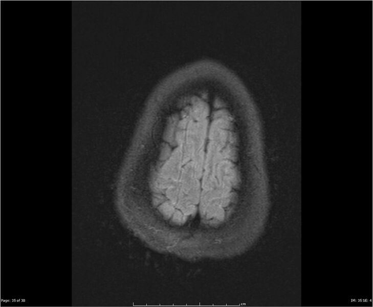 File:Brainstem glioma (Radiopaedia 21819-21775 Axial FLAIR 35).jpg