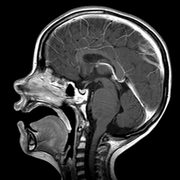 File:Brainstem glioma (Radiopaedia 5683-7390 Sagittal T1 C+ 1).jpg