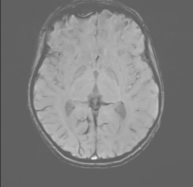 File:Brainstem glioma (Radiopaedia 70548-80674 Axial SWI 31).jpg