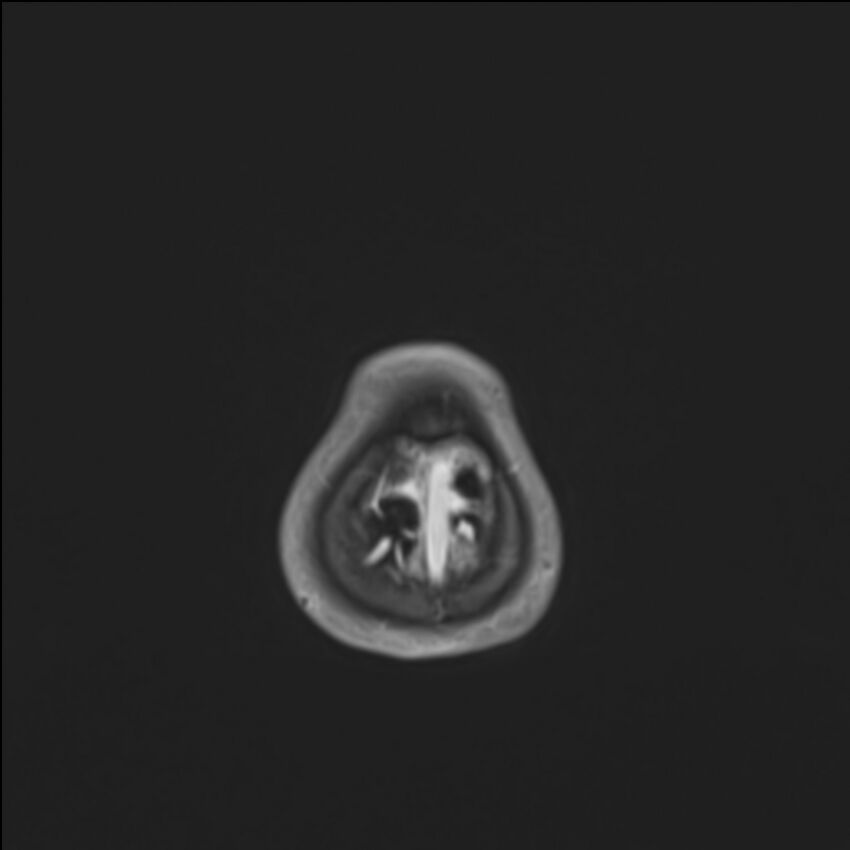 Brainstem glioma (Radiopaedia 70548-80674 Axial T1 C+ 149).jpg