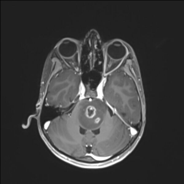 File:Brainstem glioma (Radiopaedia 70548-80674 Axial T1 C+ 49).jpg