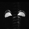 Breast implants - MRI (Radiopaedia 26864-27035 D 24).jpg