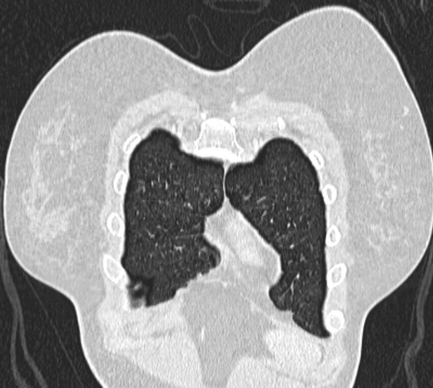 Bronchial atresia (Radiopaedia 50007-55297 Coronal lung window 5).jpg