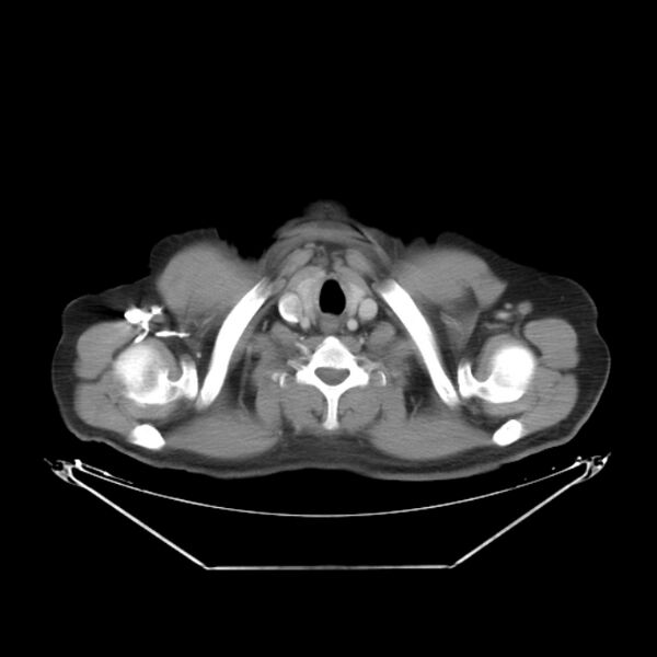 File:Bronchogenic carcinoma with upper lobe collapse (Radiopaedia 29297-29726 C 3).jpg