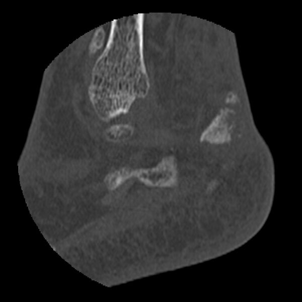 File:Calcaneal tuberosity avulsion fracture (Radiopaedia 22649-22668 D 4).jpg