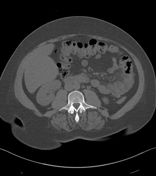 File:Calcified hepatic hydatid cyst (Radiopaedia 81127-94738 Axial non-contrast 51).jpg