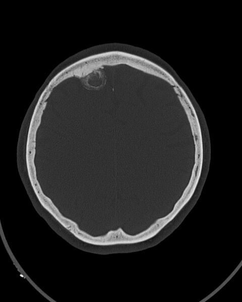File:Calcified meningioma (Radiopaedia 74361-85243 Axial bone window 12).jpg