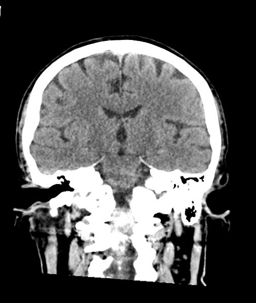 File:Calcified meningioma (Radiopaedia 74361-85243 Coronal non-contrast 30).jpg