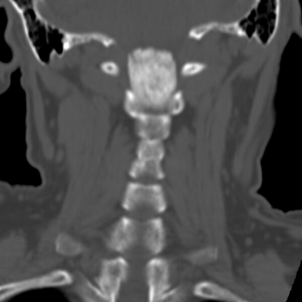 File:Calcified meningioma - cervical canal (Radiopaedia 70136-80171 Coronal bone window 22).jpg