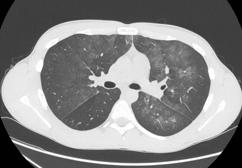 File:Cannabis-induced diffuse alveolar hemorrhage (Radiopaedia 89834-106946 Axial lung window 47).jpg
