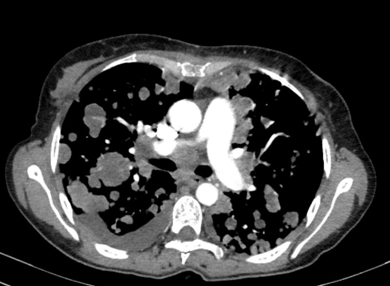 File:Cannonball metastases from breast cancer (Radiopaedia 91024-108569 A 52).jpg