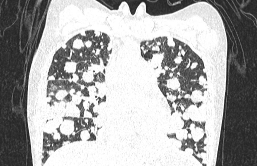 Cannonball metastases from breast cancer (Radiopaedia 91024-108569 Coronal lung window 58).jpg