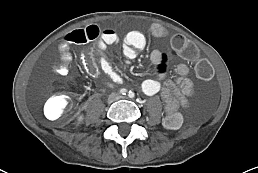 Carcinoid mesenteric tumor complicated by chylous ascites (Radiopaedia 76312-87953 A 45).jpg