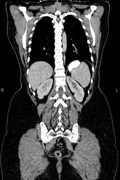 File:Carcinoma of uterine cervix (Radiopaedia 85861-101700 C 44).jpg