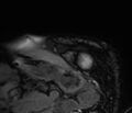 Cardiac amyloidosis (Radiopaedia 39736-42124 F 25).jpg