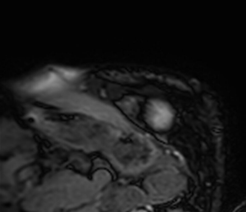 Cardiac amyloidosis (Radiopaedia 39736-42124 F 25).jpg