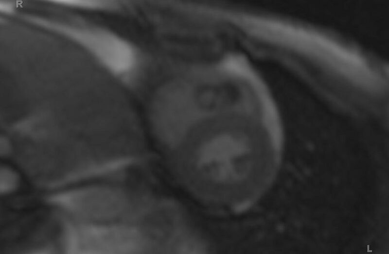 File:Cardiac hemangioma (Radiopaedia 31709-32631 Short axis 67).jpg