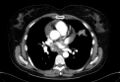 Cardiac sarcoidosis (Radiopaedia 74548-85534 A 42).jpg