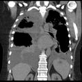 Cardiogenic pulmonary edema (Radiopaedia 29213-29609 Coronal non-contrast 28).jpg