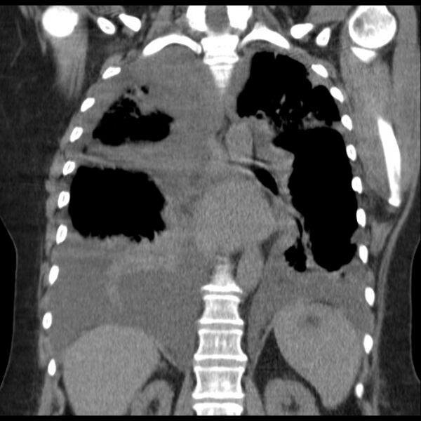 File:Cardiogenic pulmonary edema (Radiopaedia 29213-29609 Coronal non-contrast 28).jpg