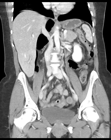 File:Cecum hernia through the foramen of Winslow (Radiopaedia 46634-51112 B 25).png