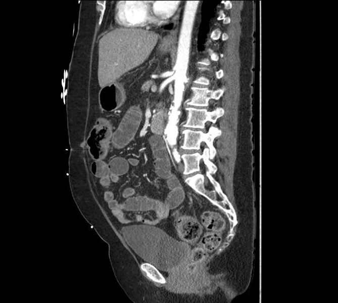 File:Celiac artery severe stenosis and dissection (Radiopaedia 44128-47842 A 19).jpg