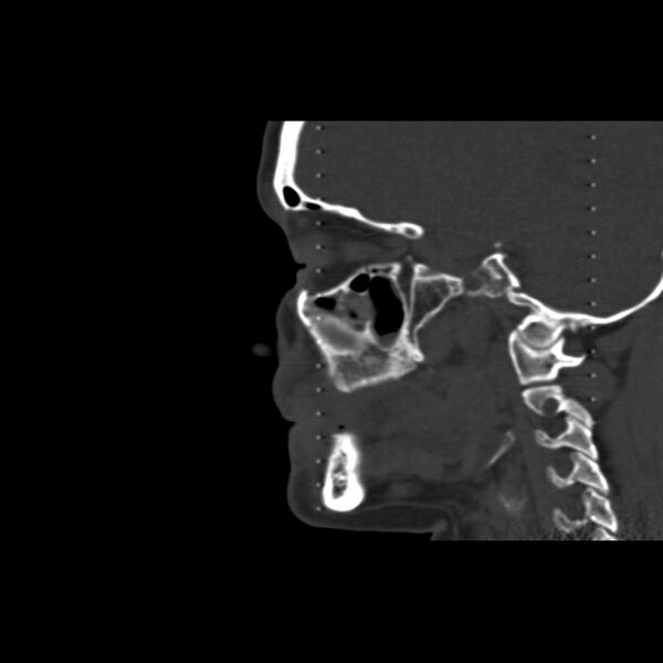 File:Cemento-ossifying fibroma (Radiopaedia 21243-21149 Sagittal bone window 2).jpg
