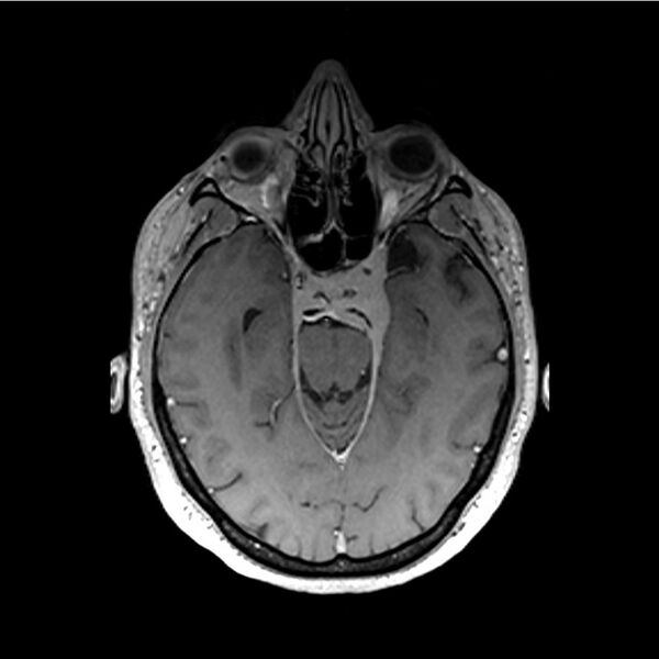 File:Central base of skull meningioma (Radiopaedia 53531-59549 Axial T1 C+ 19).jpg
