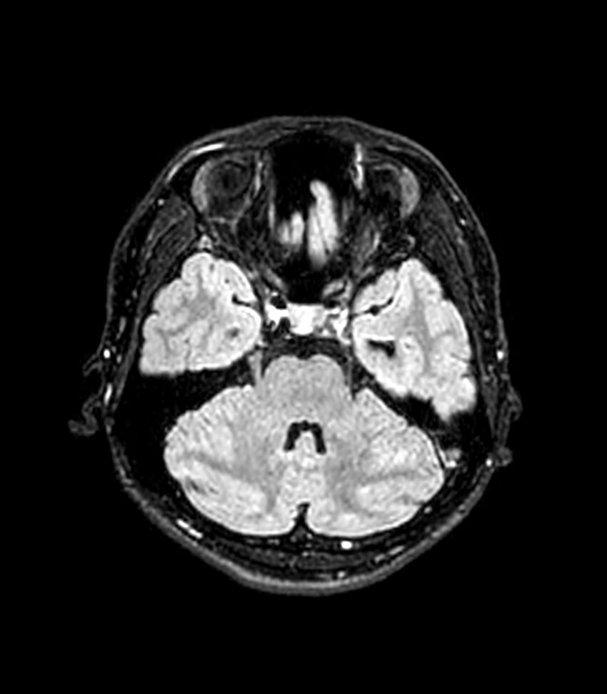 Central neurocytoma (Radiopaedia 79320-92380 Axial FLAIR 216).jpg