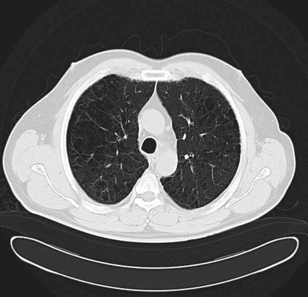 File:Centrilobular pulmonary emphysema (Radiopaedia 26808-26971 C 14).jpg