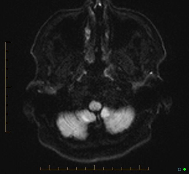 File:Cerebellar gangliocytoma (Radiopaedia 65377-74422 Axial DWI 3).jpg
