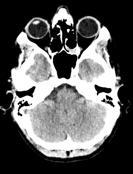 File:Cerebral abscess (Radiopaedia 60342-68008 Axial non-contrast 12).png