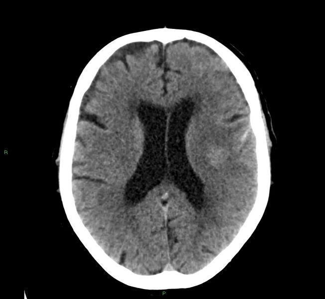 File:Cerebral amyloid angiopathy-associated lobar intracerebral hemorrhage (Radiopaedia 58376-65511 Axial non-contrast 26).jpg
