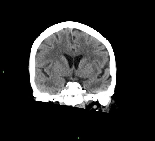 File:Cerebral amyloid angiopathy-associated lobar intracerebral hemorrhage (Radiopaedia 58378-65516 Coronal non-contrast 37).jpg