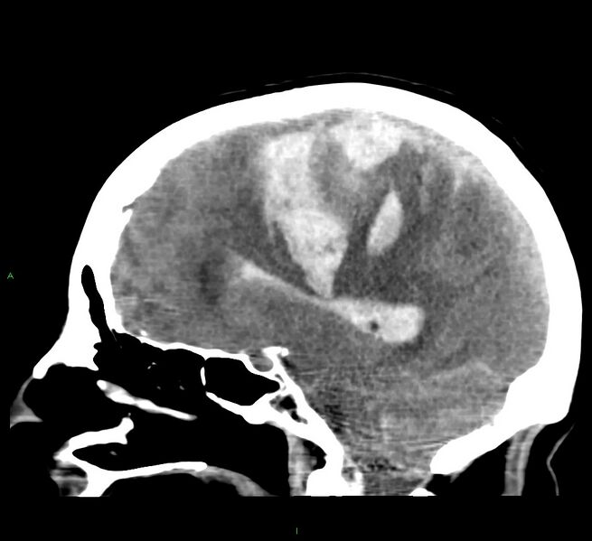 File:Cerebral amyloid angiopathy-associated lobar intracerebral hemorrhage (Radiopaedia 58379-65519 C 26).jpg