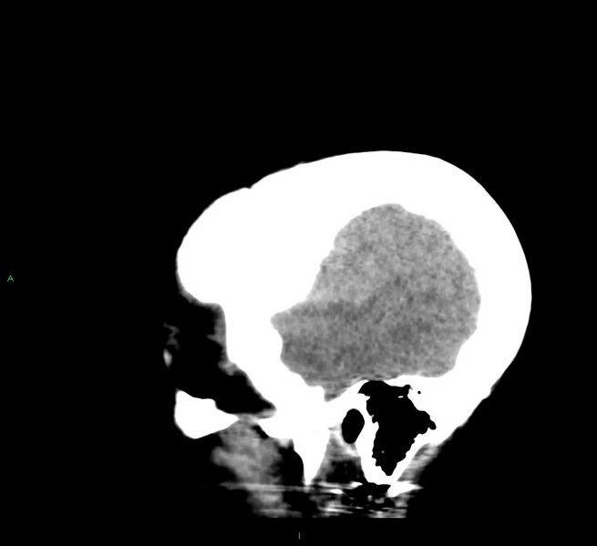 File:Cerebral amyloid angiopathy-associated lobar intracerebral hemorrhage (Radiopaedia 58379-65519 C 46).jpg