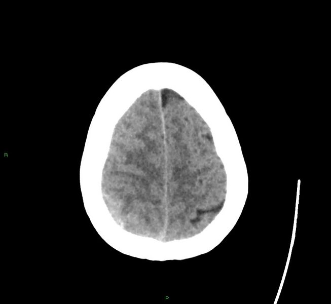 File:Cerebral amyloid angiopathy-associated lobar intracerebral hemorrhage (Radiopaedia 58563-65727 Axial non-contrast 13).jpg